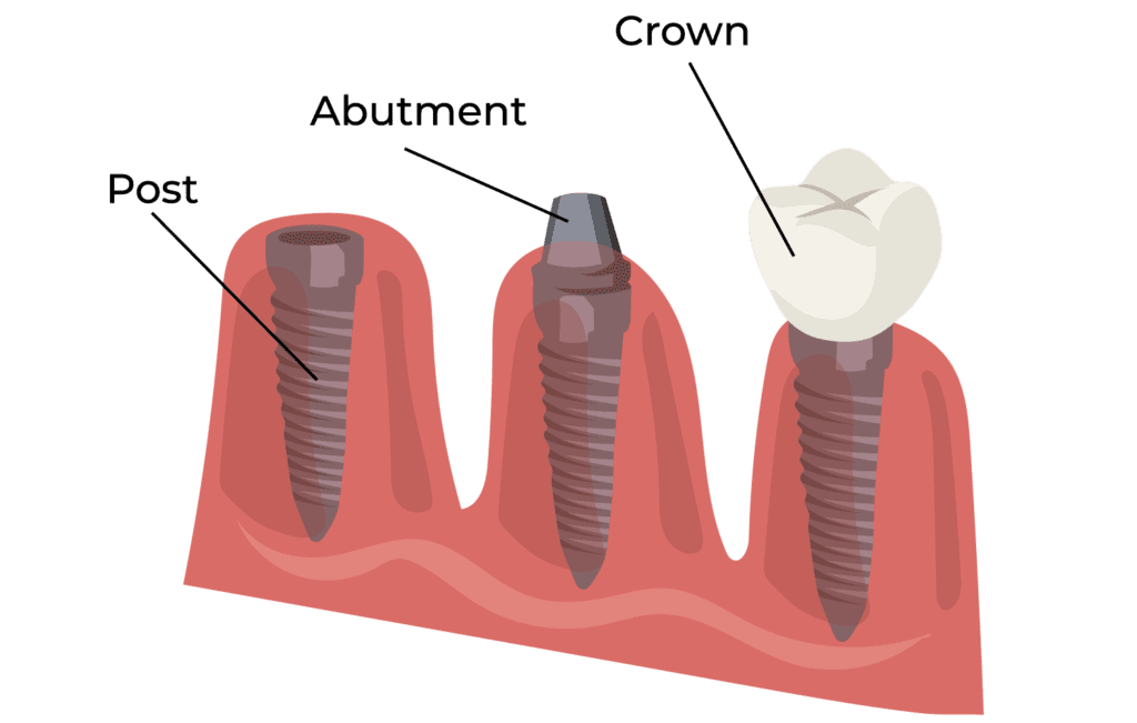 Dental Implants in Houston