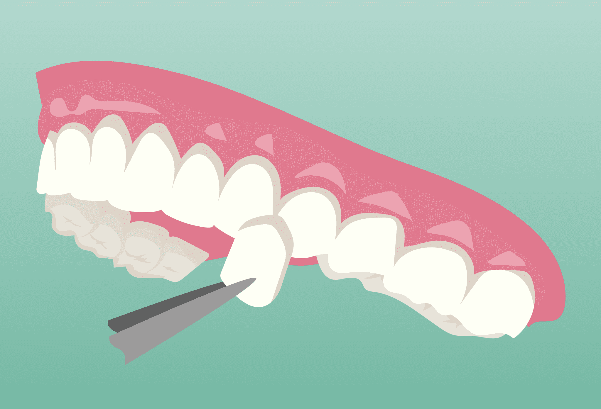 Veneers Porcelain Veneers in Houston