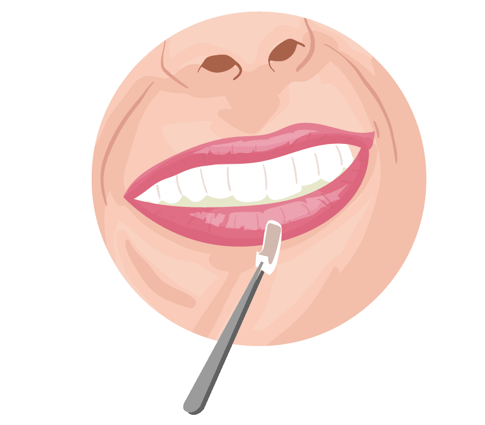 Veneers Porcelain Veneers in Houston