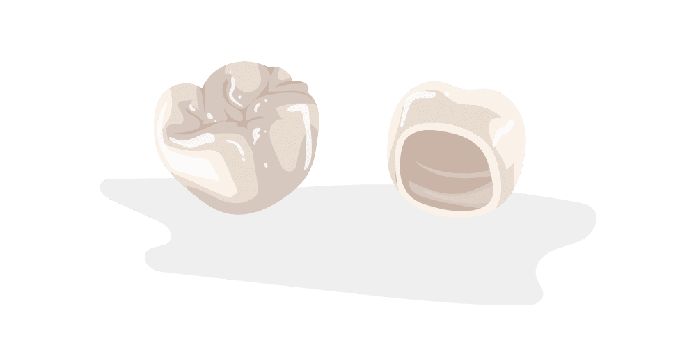 crowns-part-3 copy Dental crown procedures in Houston