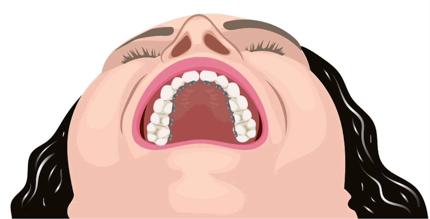 broken tooth emergency dental care