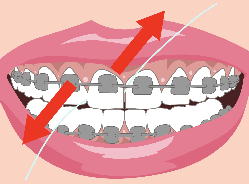 cosmetic dentistry porcelain veneers