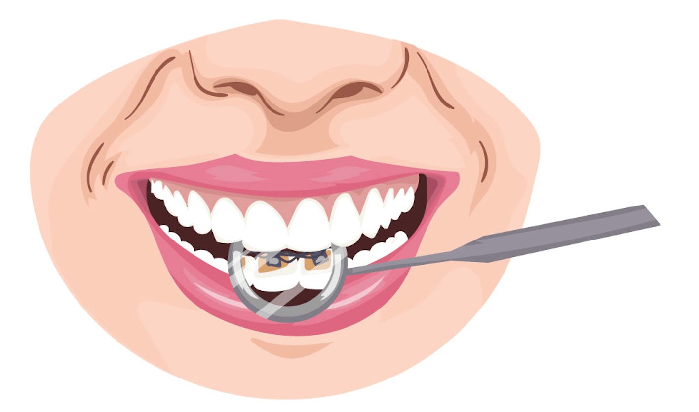 cracked tooth chipped tooth