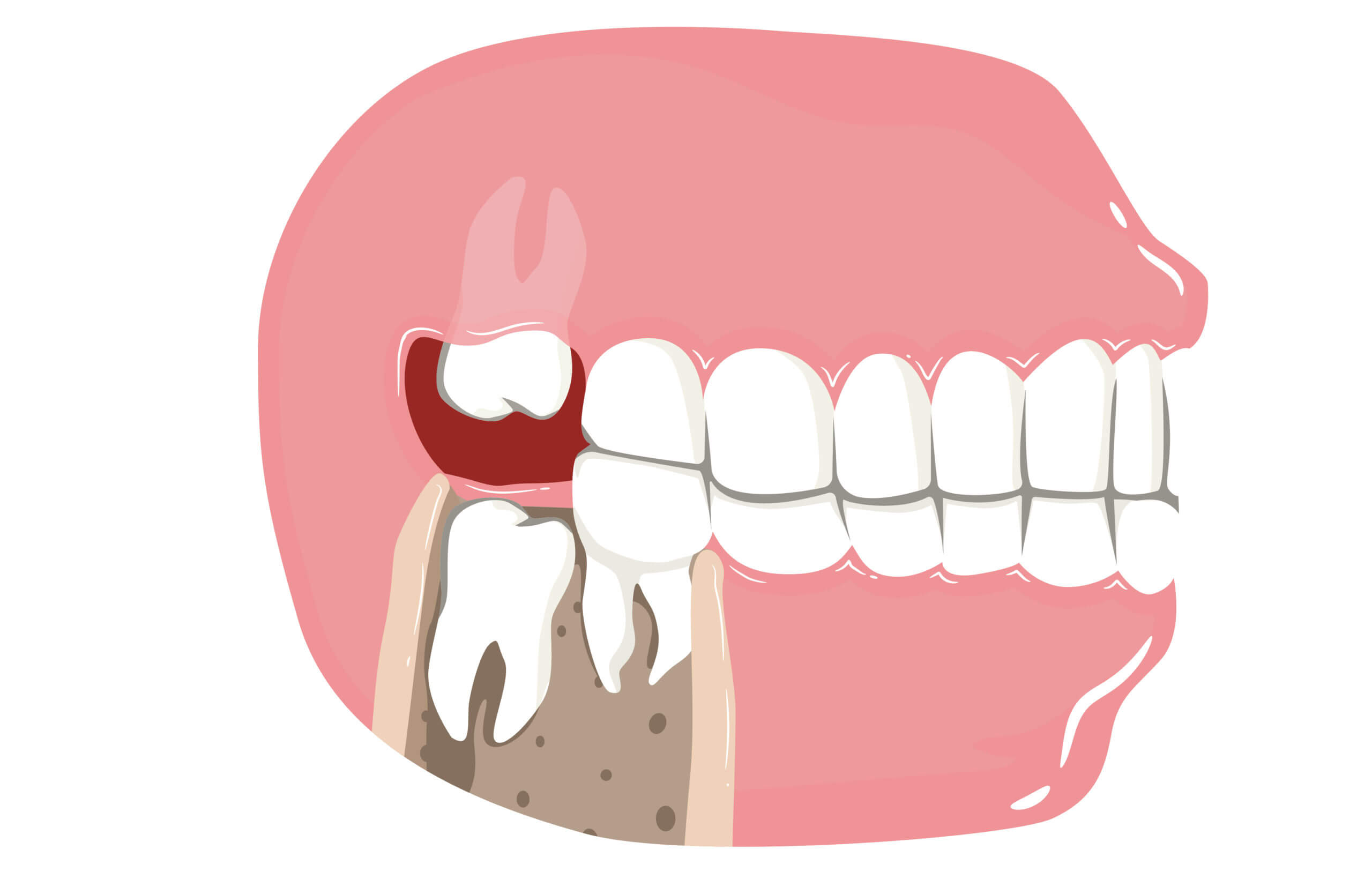 tooth crown dental implants
