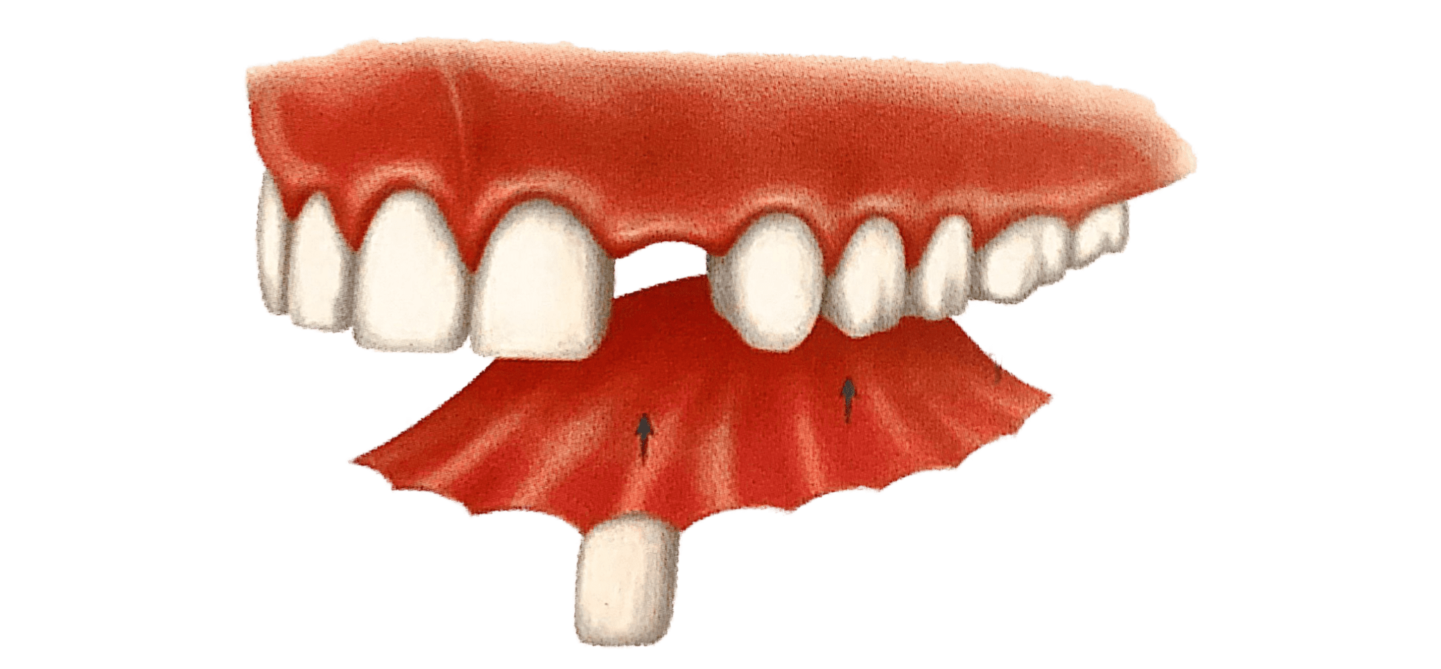 Single missing teeth