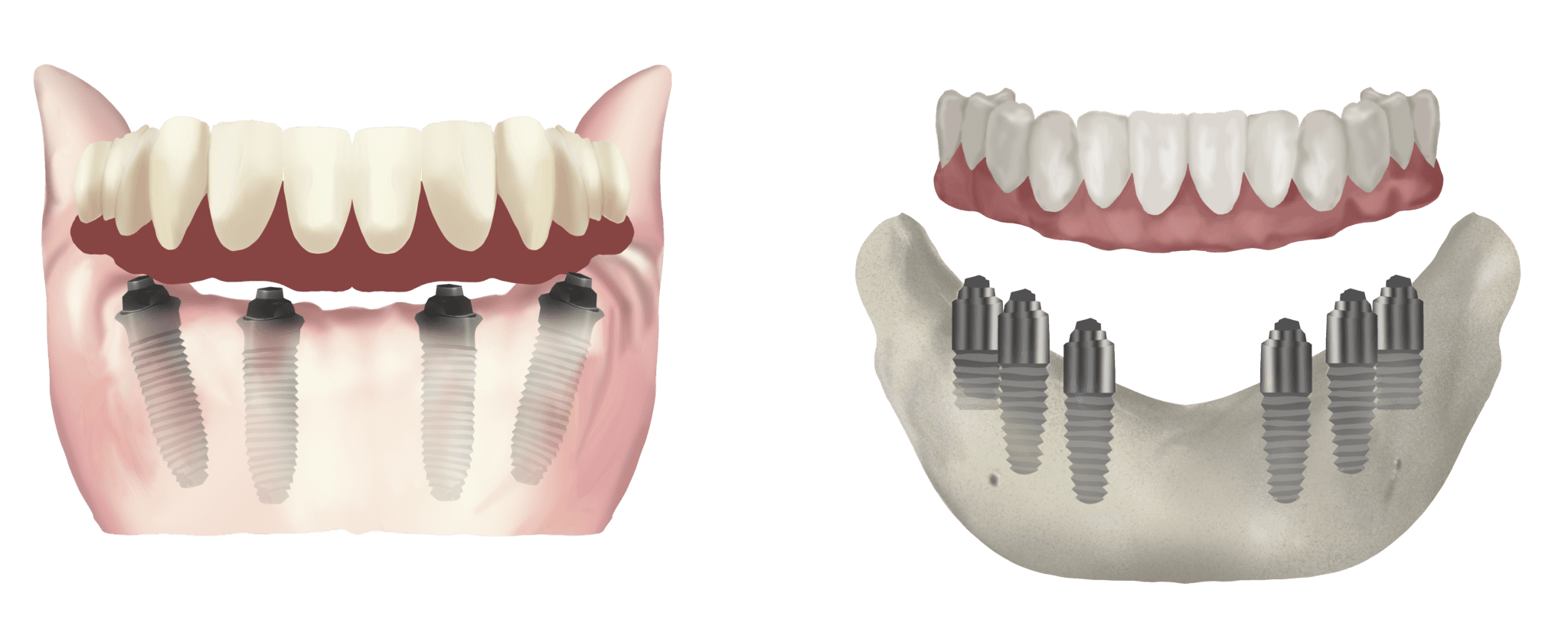 all-on-6 dental implants in Houston
